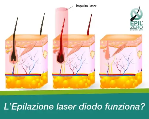 epilazione laser diodo funziona